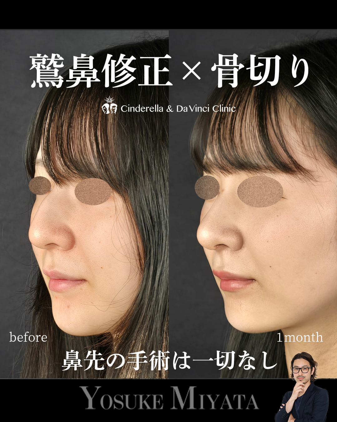 鷲鼻と骨切りのみの画像