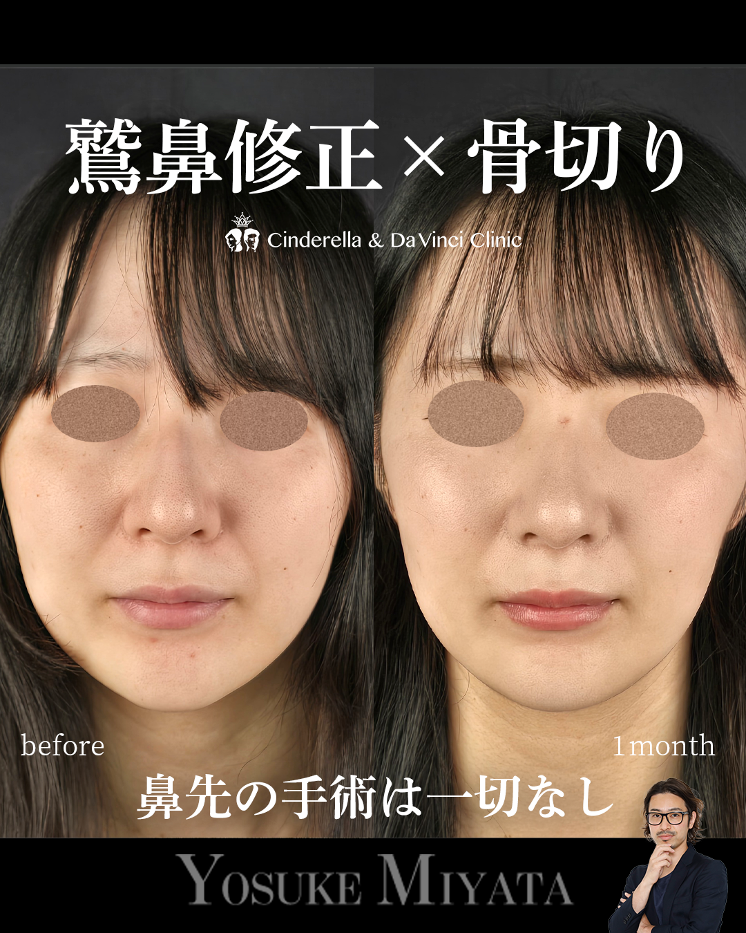 鷲鼻と骨切りのみの画像