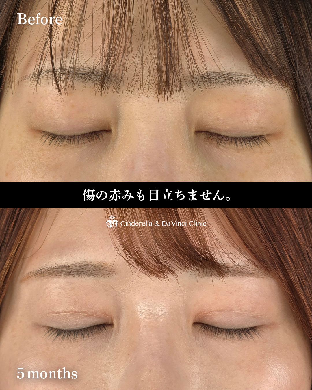 眼瞼下垂手術の画像