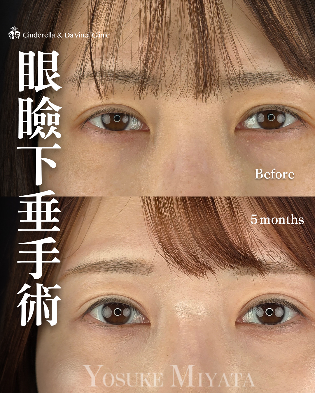 美容眼瞼下垂手術テキスト（英語版） 眼瞼下垂手術の症例一覧 | 名古屋の美容外科・美容皮膚科なら