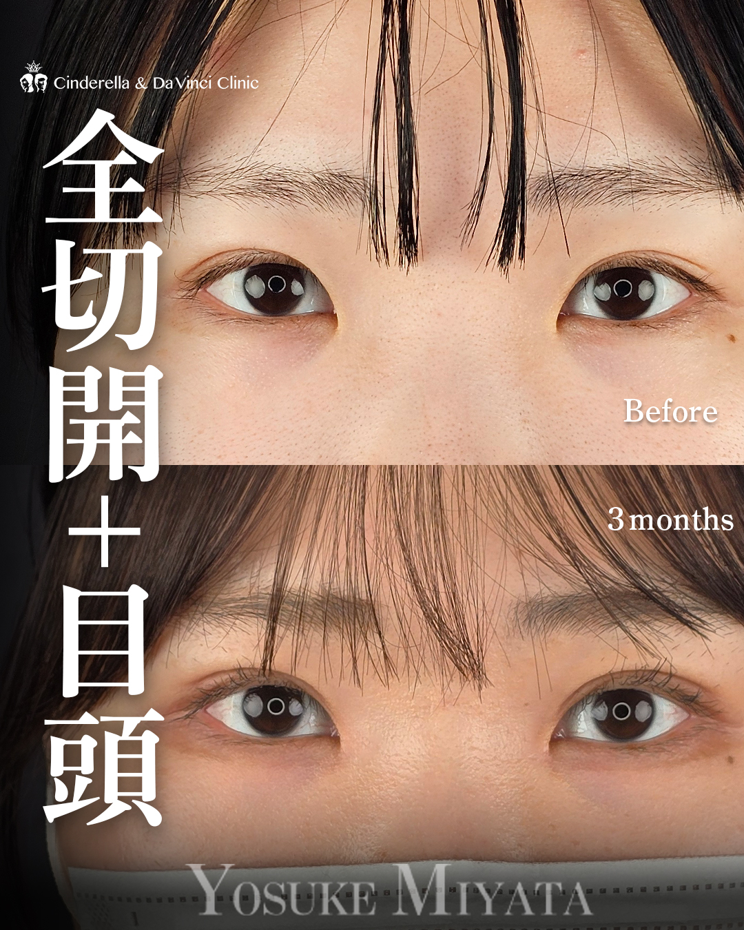 埋没後の全切開