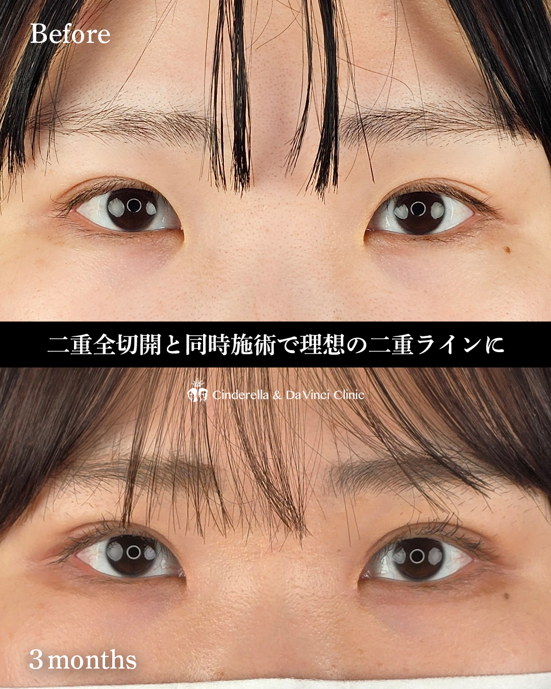 埋没後の全切開の画像