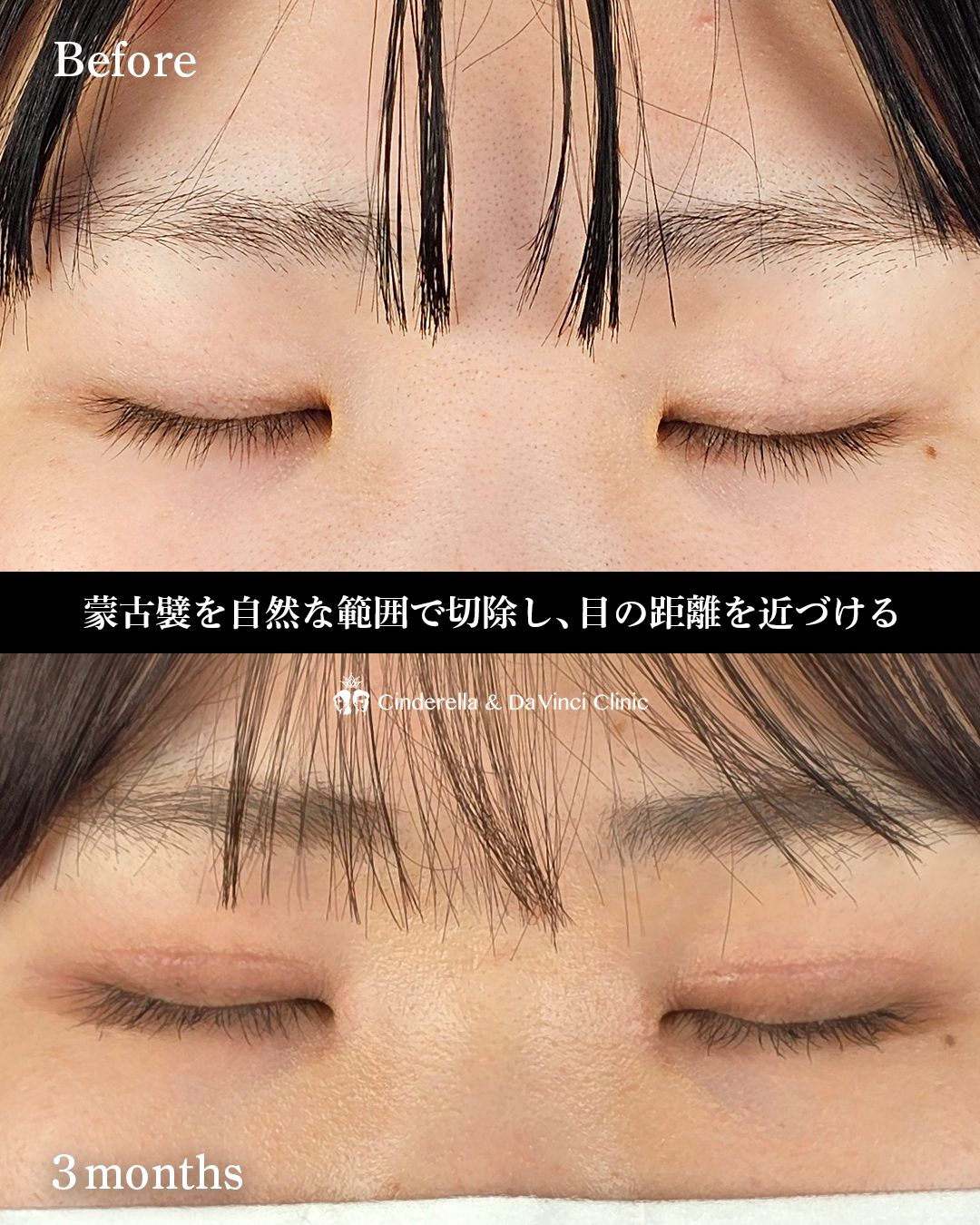 埋没後の全切開の画像