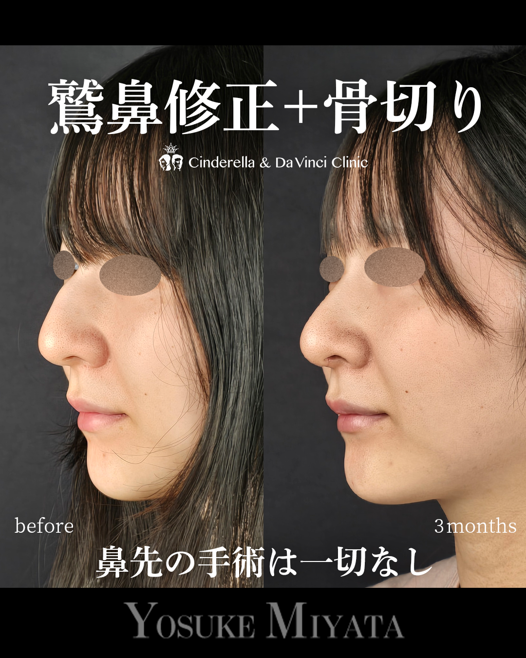 鷲鼻と骨切りのみの画像