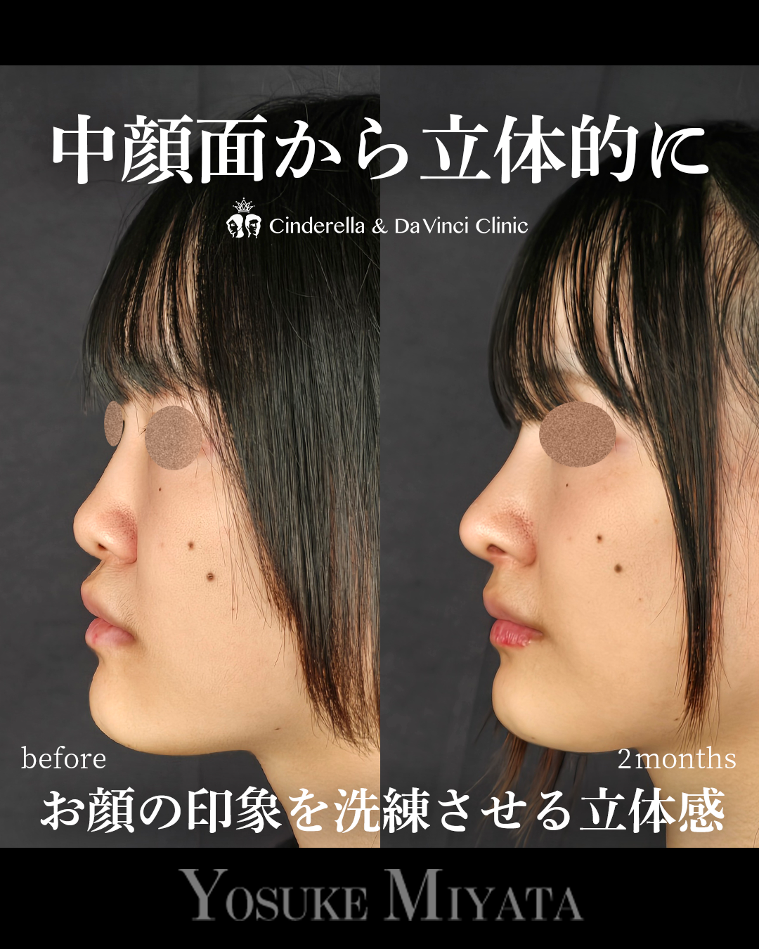 横顔に立体感を出す