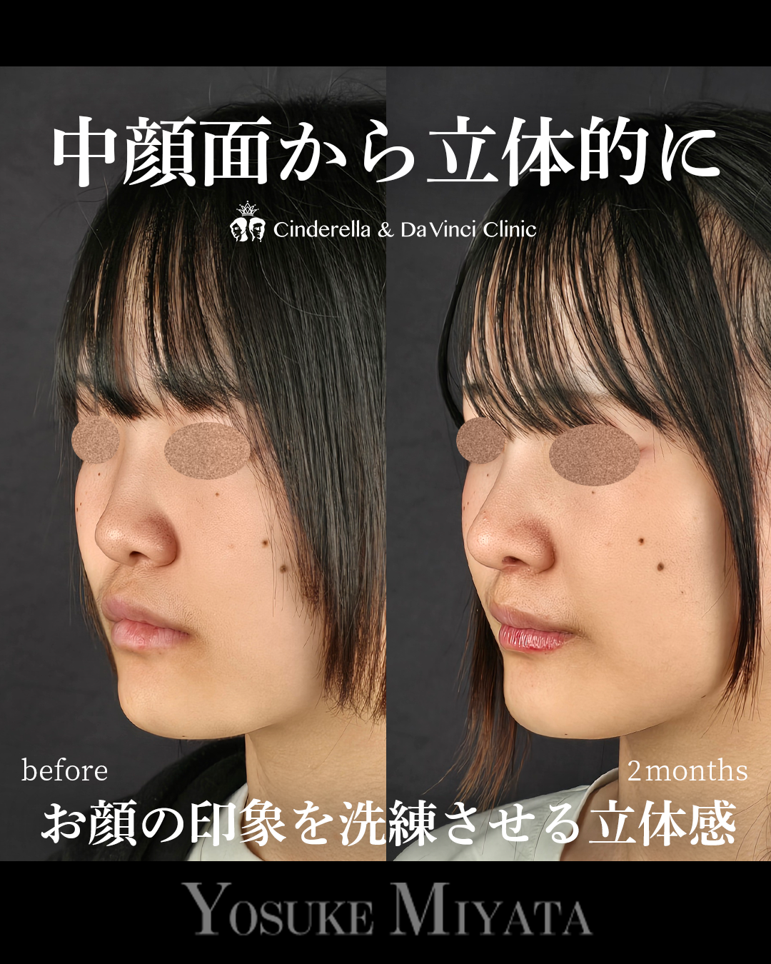 横顔に立体感を出すの画像