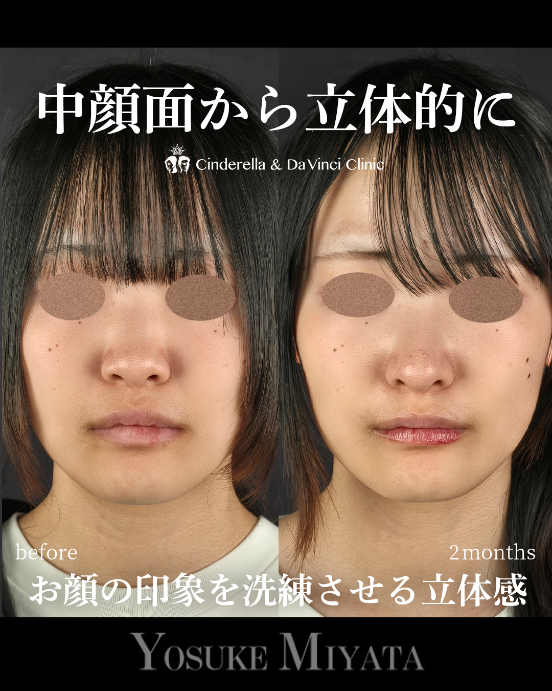 横顔に立体感を出すの画像
