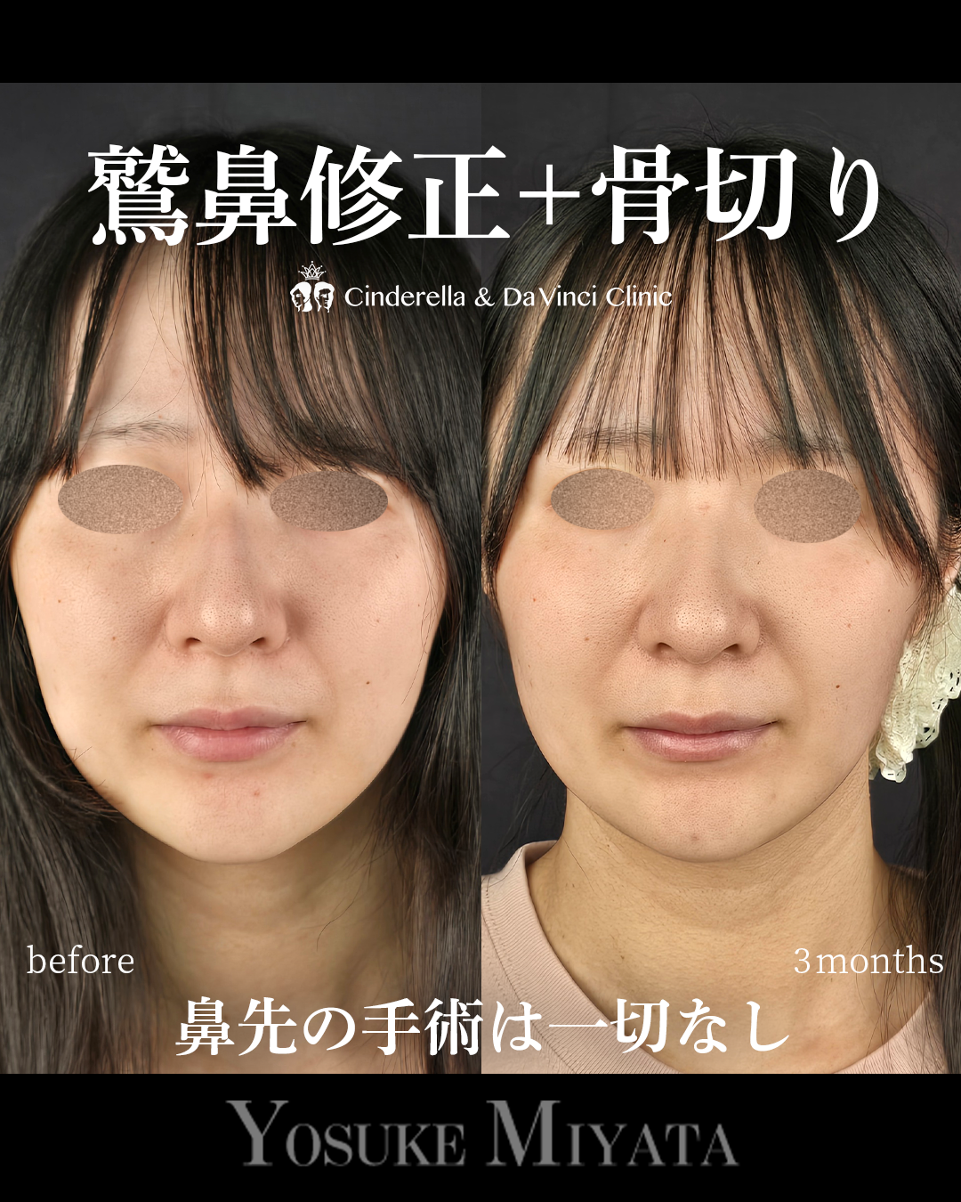 鷲鼻と骨切りのみの画像