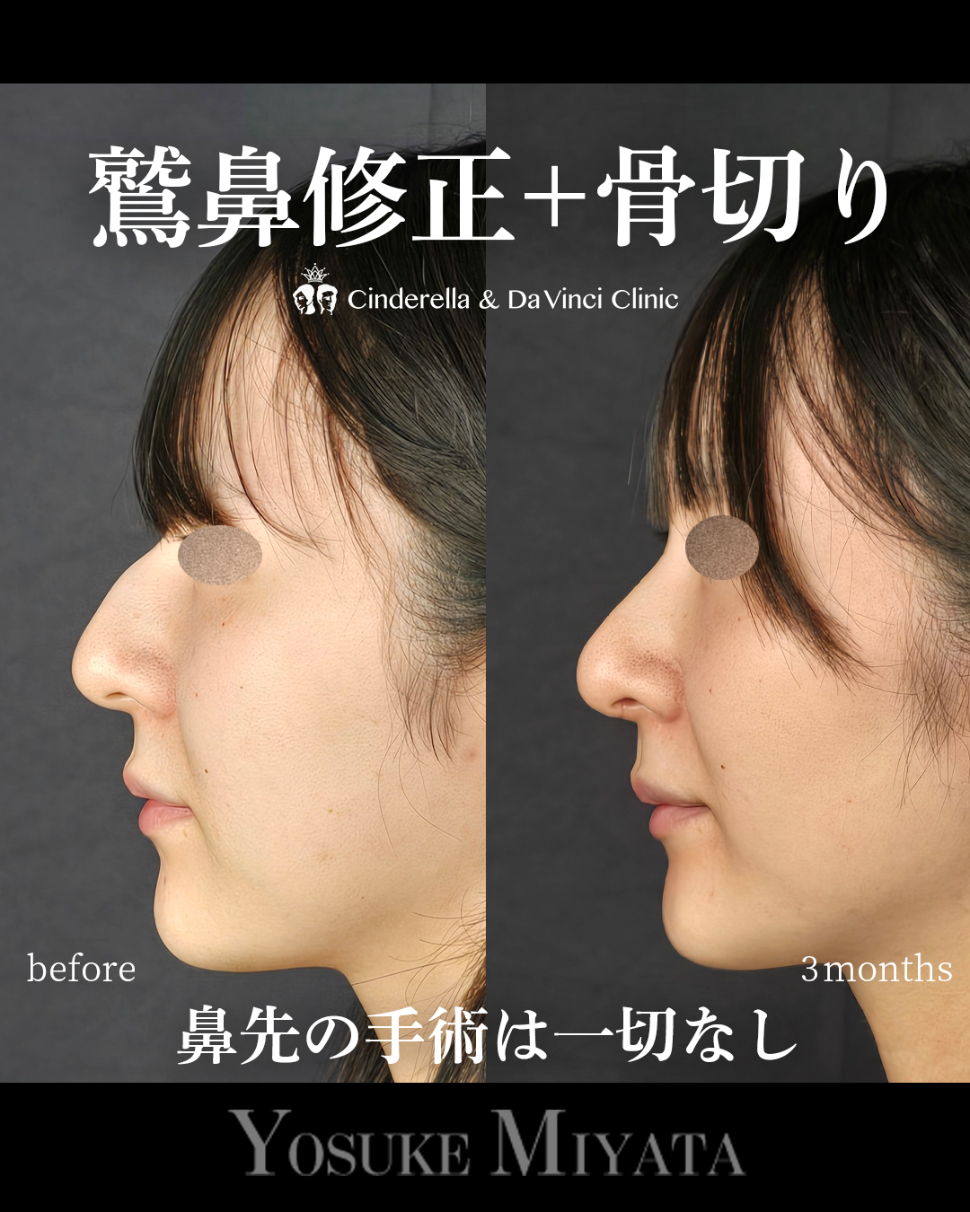 鷲鼻と骨切りのみの画像