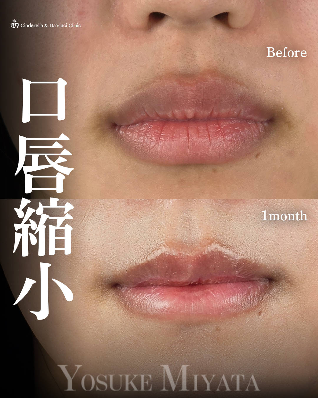 口唇縮小