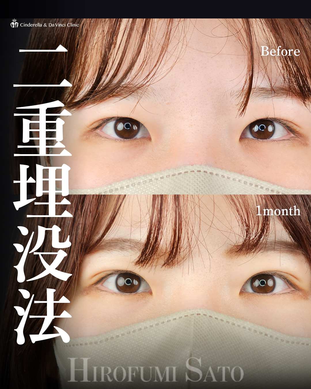 ナチュラル埋没