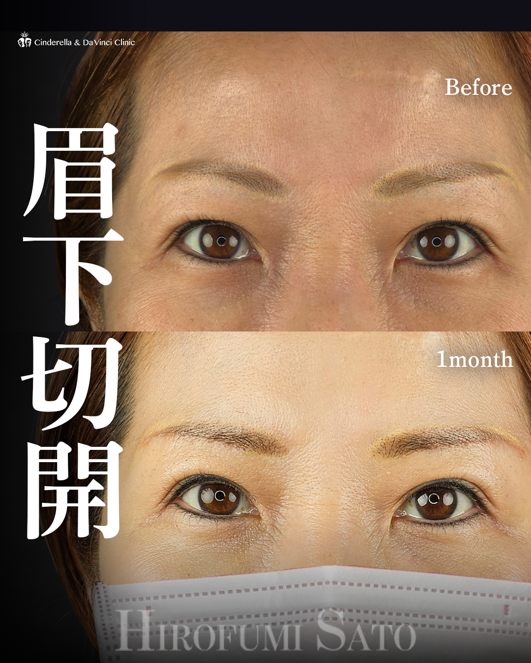 眉下切開でたるみ切除