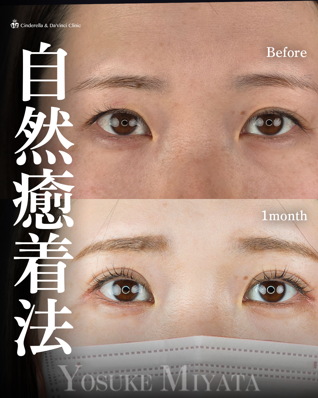 自然癒着法で二重に