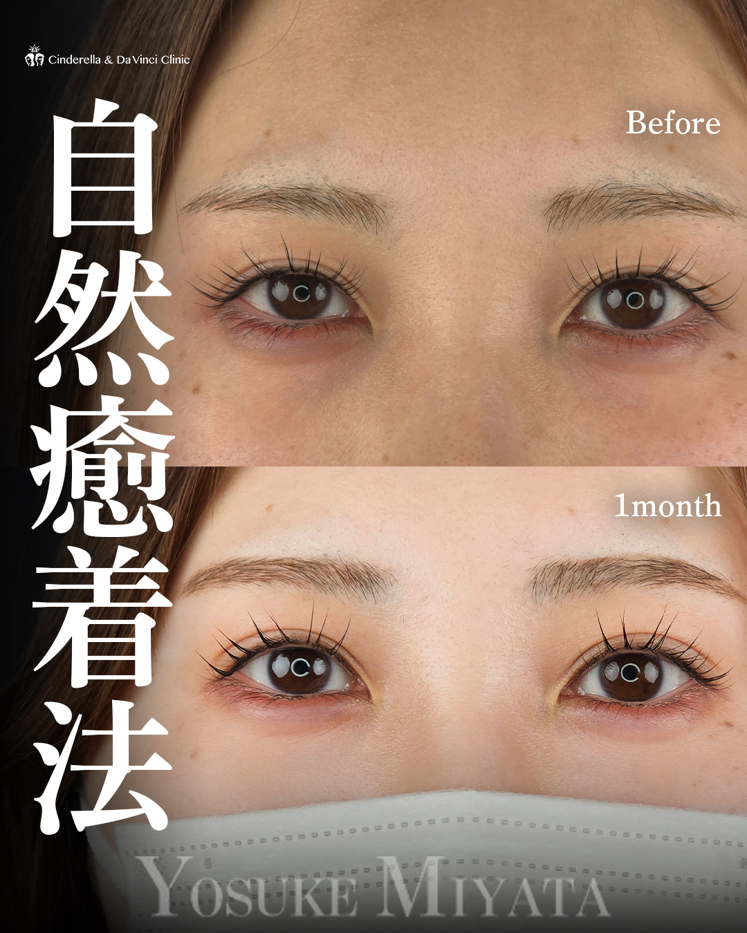 華やかで美しい二重