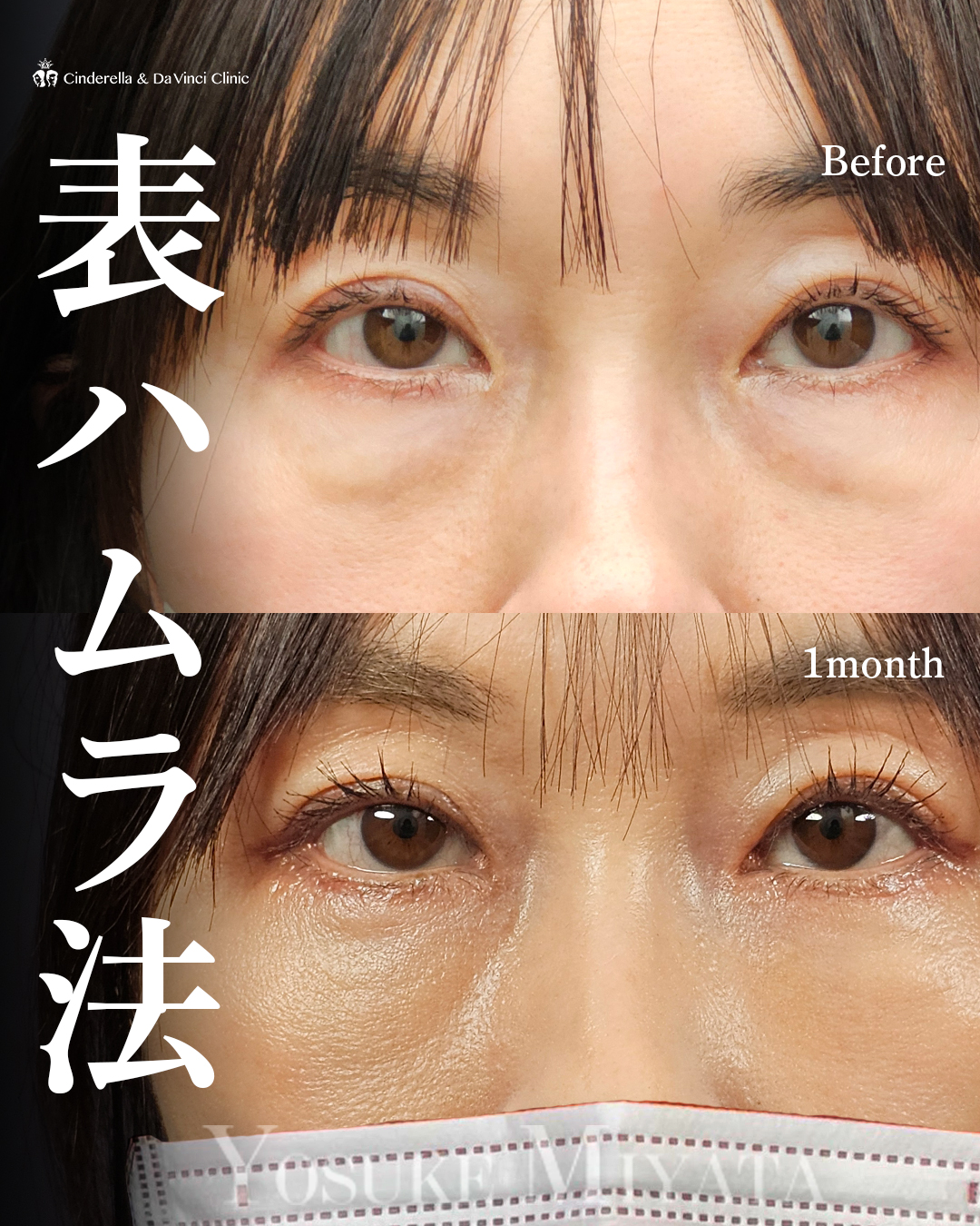 表ハムラ法