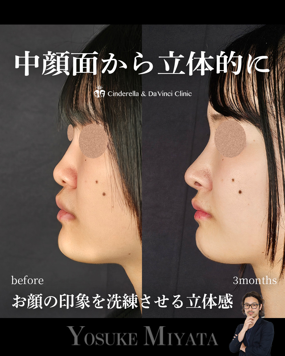 横顔に立体感を出すの画像