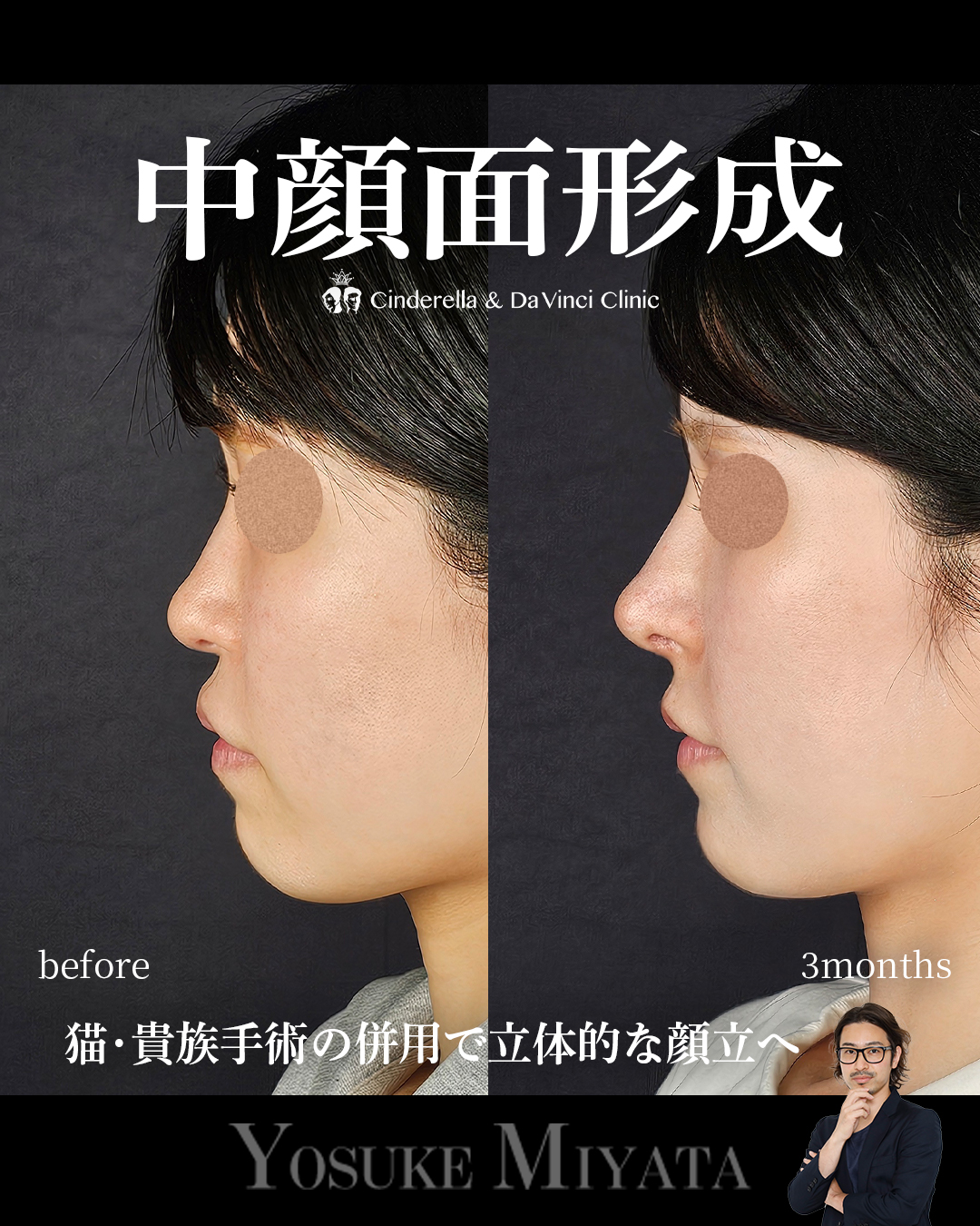 中顔面形成の画像