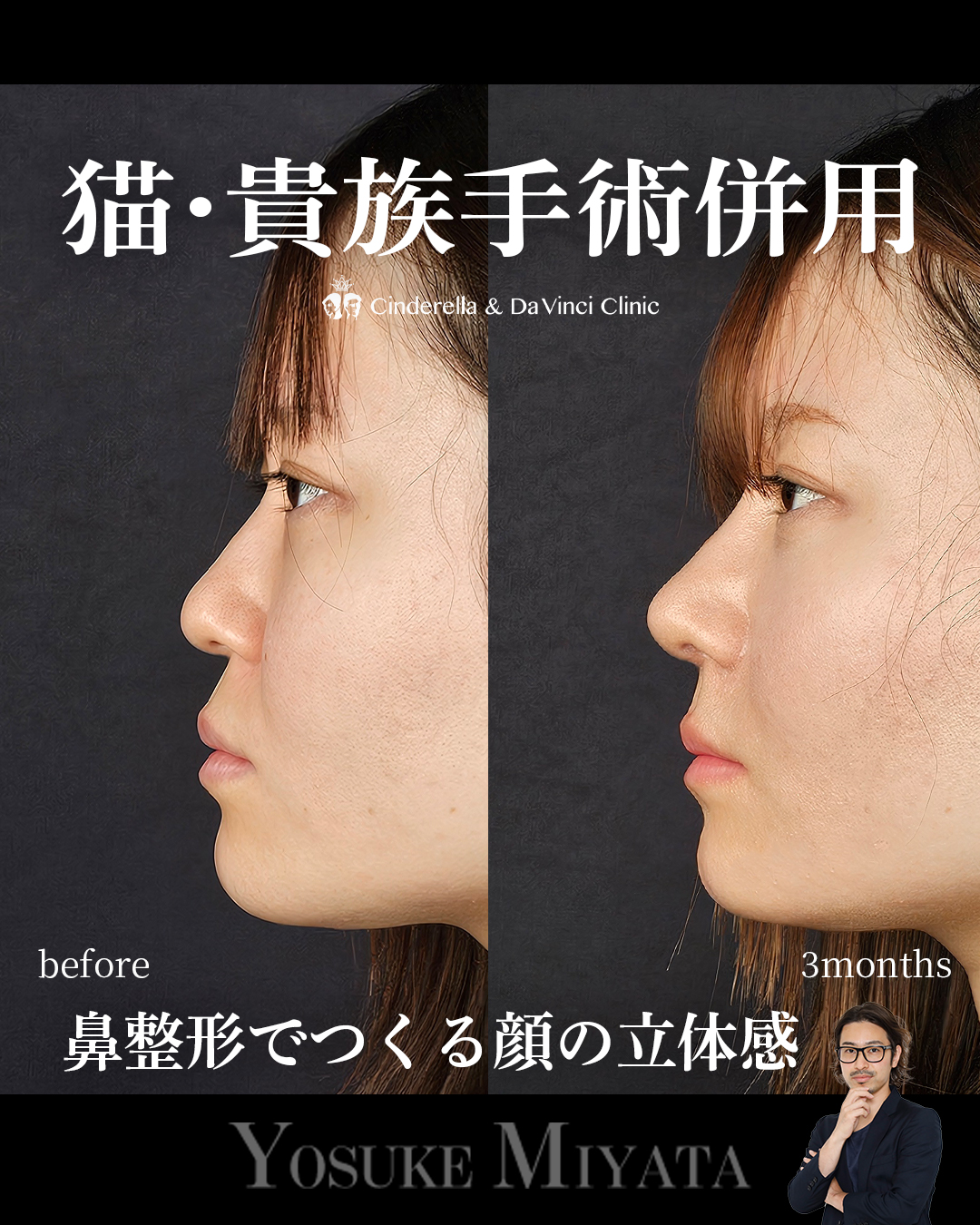 鼻整形のみで垢抜けの画像
