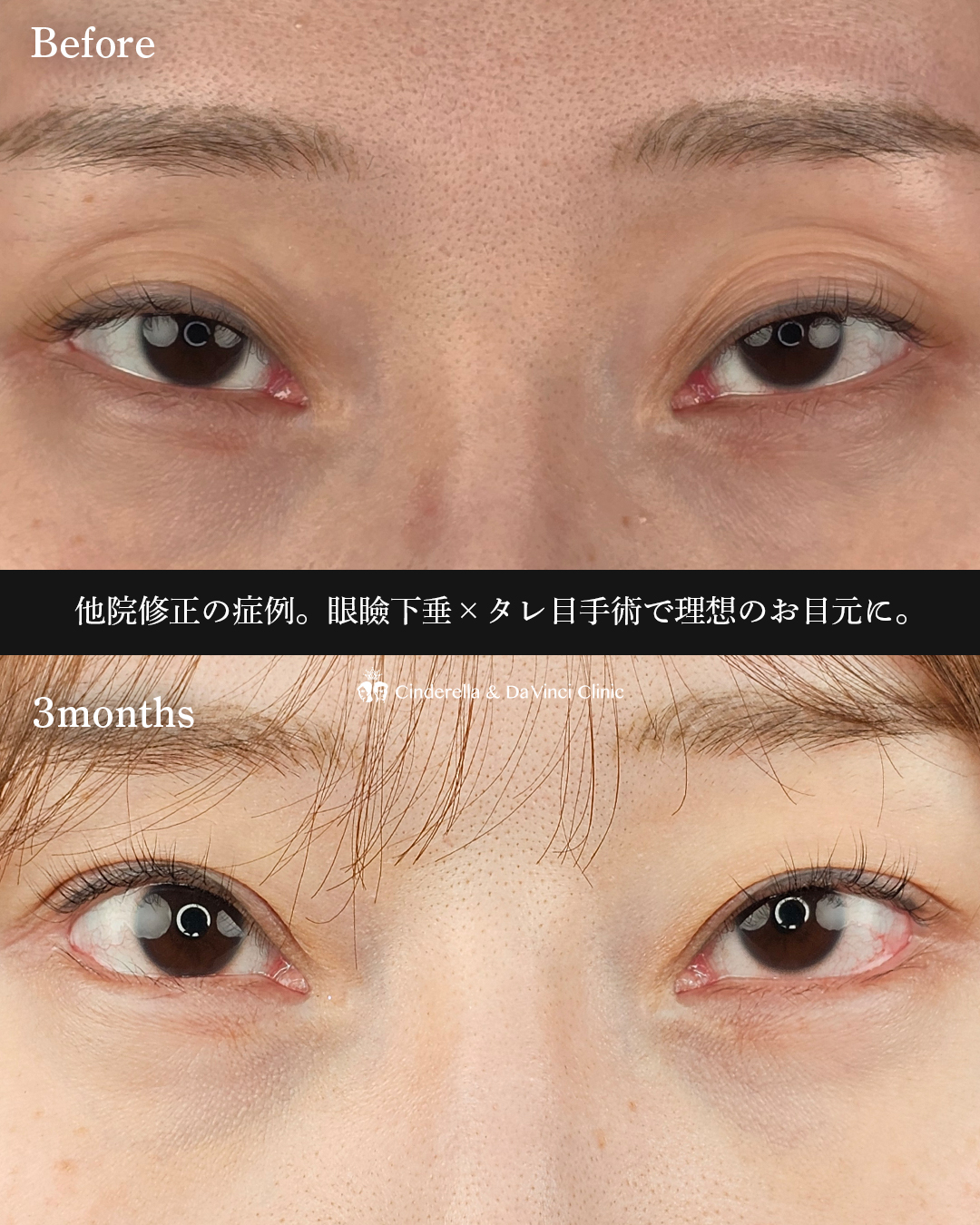 目元の他院修正の画像
