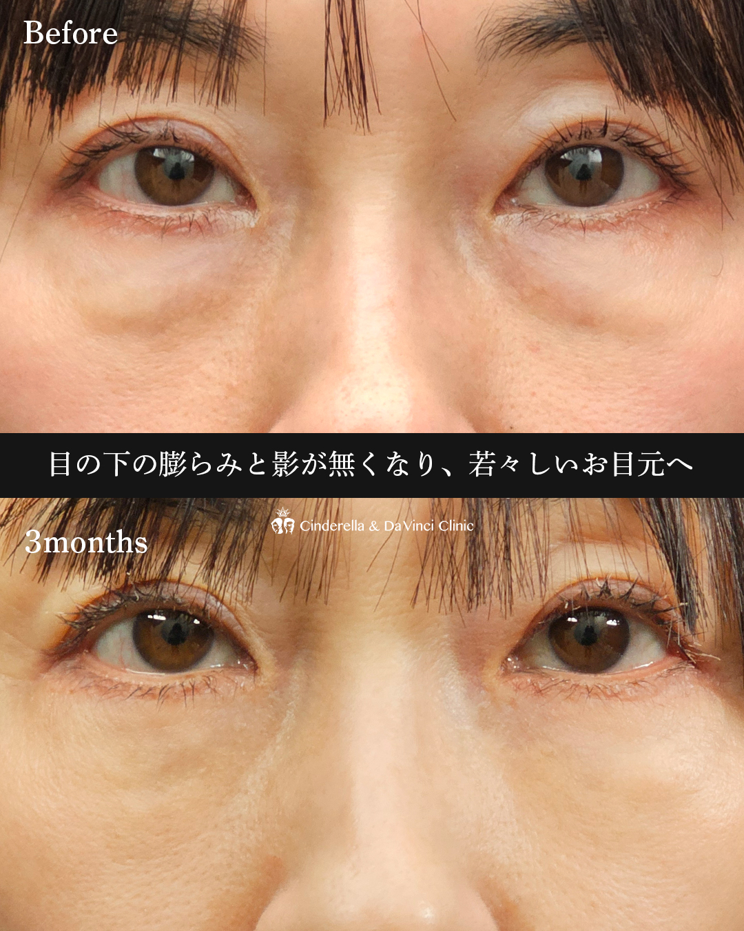 表ハムラ法の画像