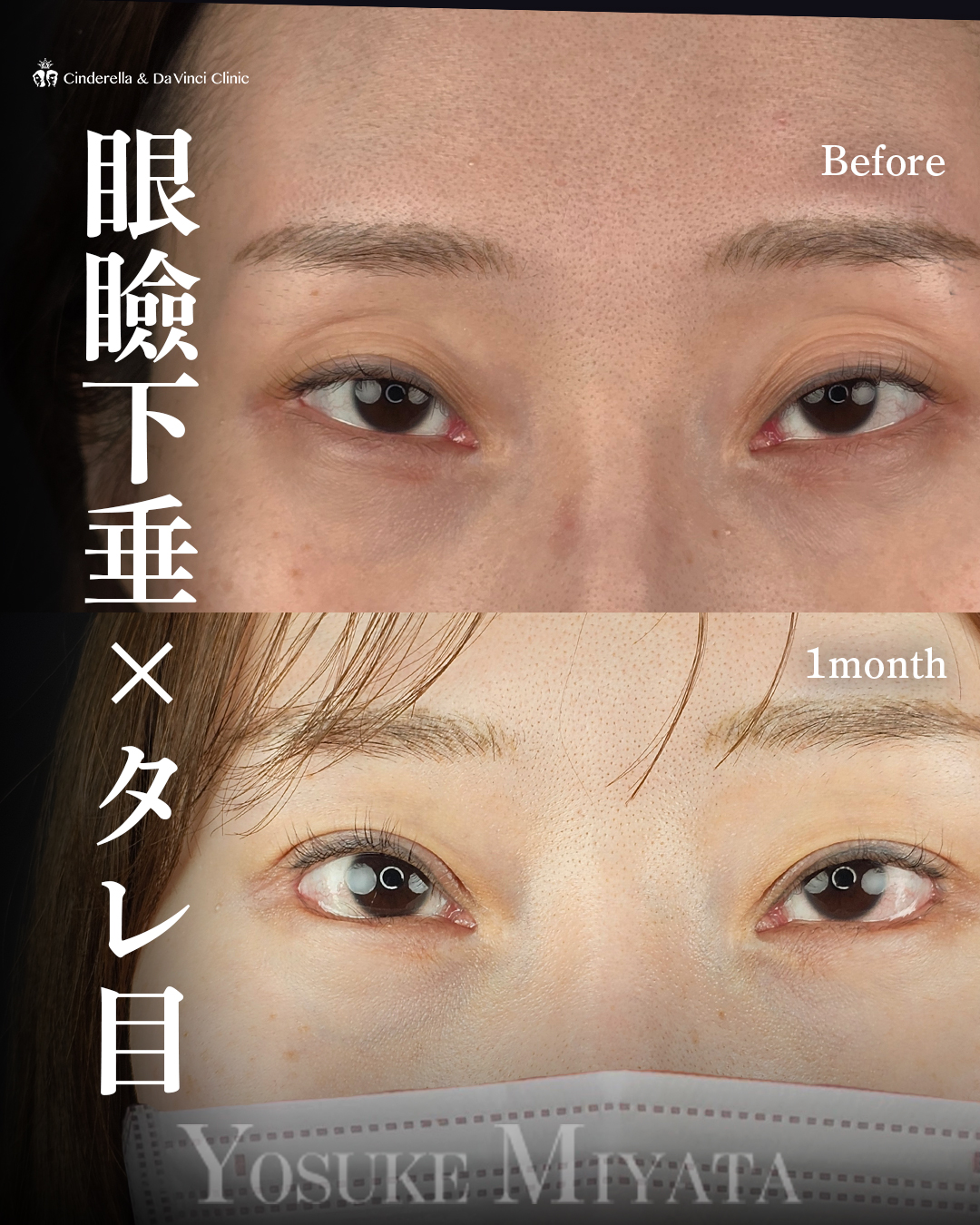 目元の他院修正