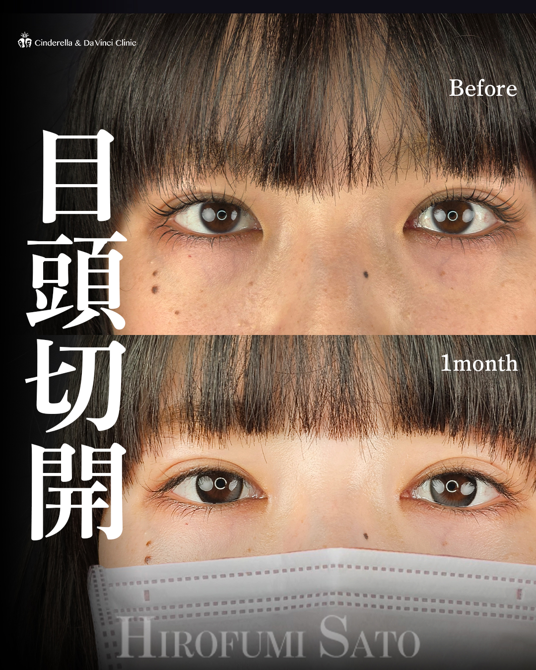 目頭切開のみ