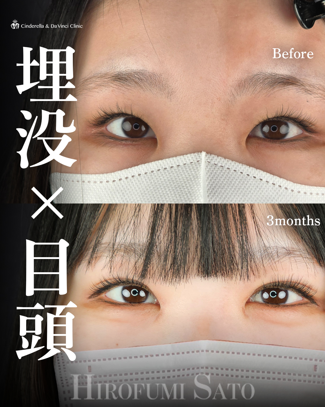 埋没×目頭