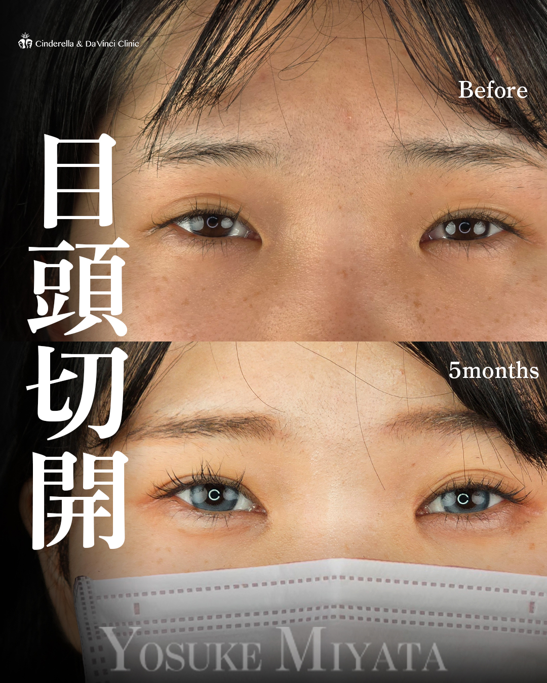 目頭切開のみ