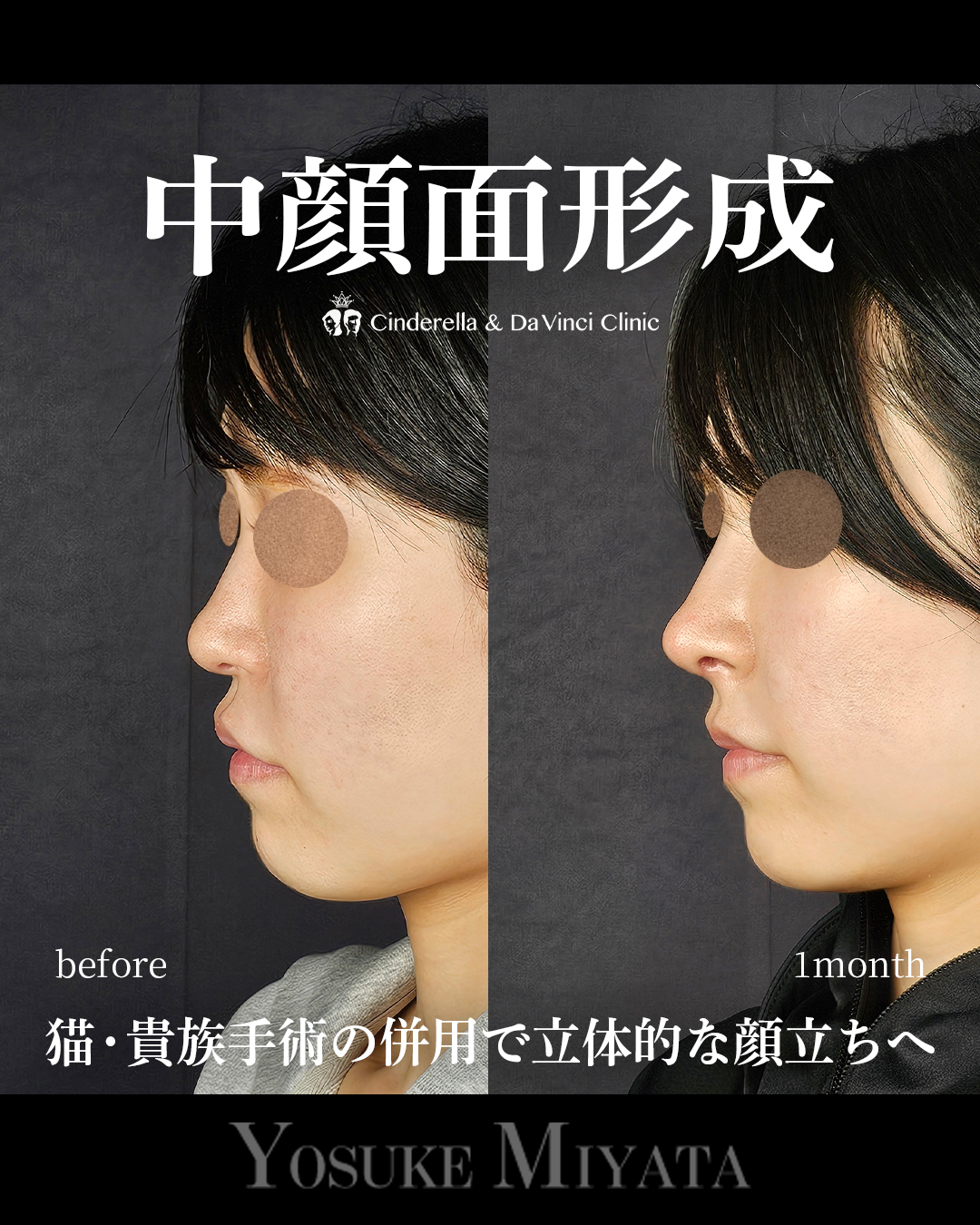 中顔面形成