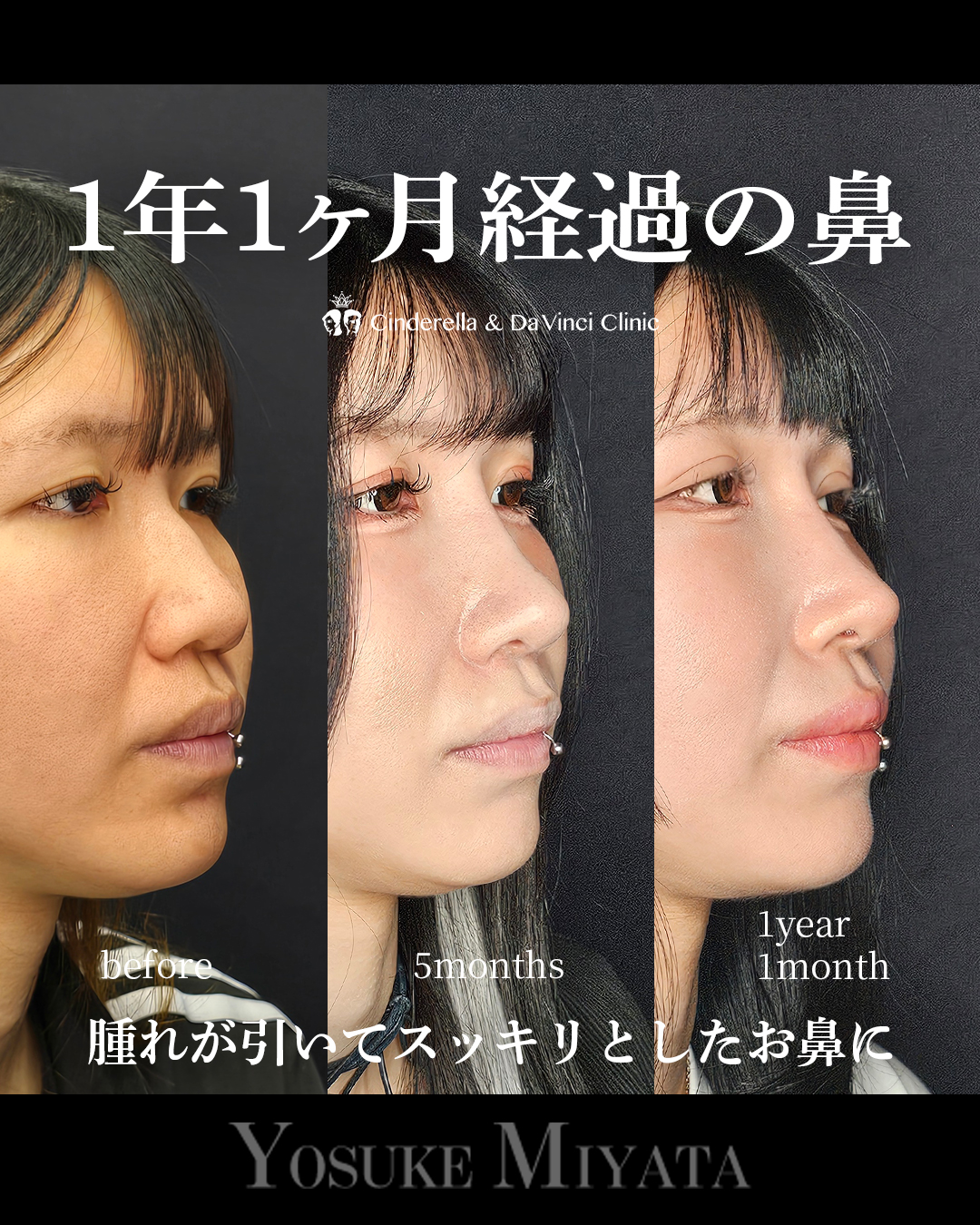 1年1ヶ月経過の鼻の画像