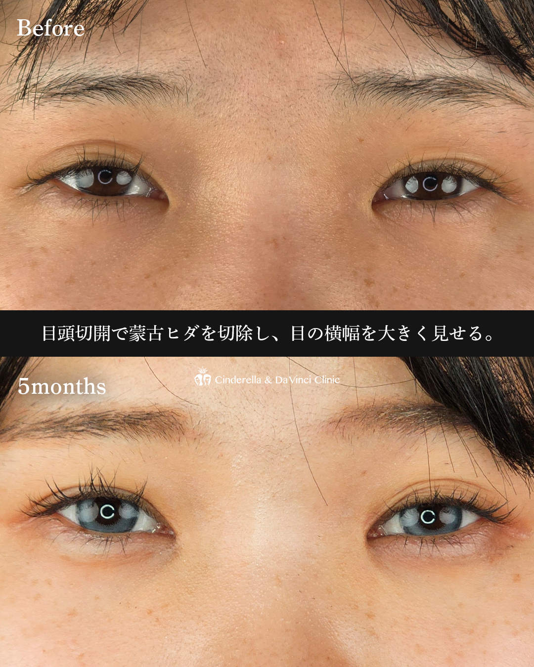目頭切開のみの画像