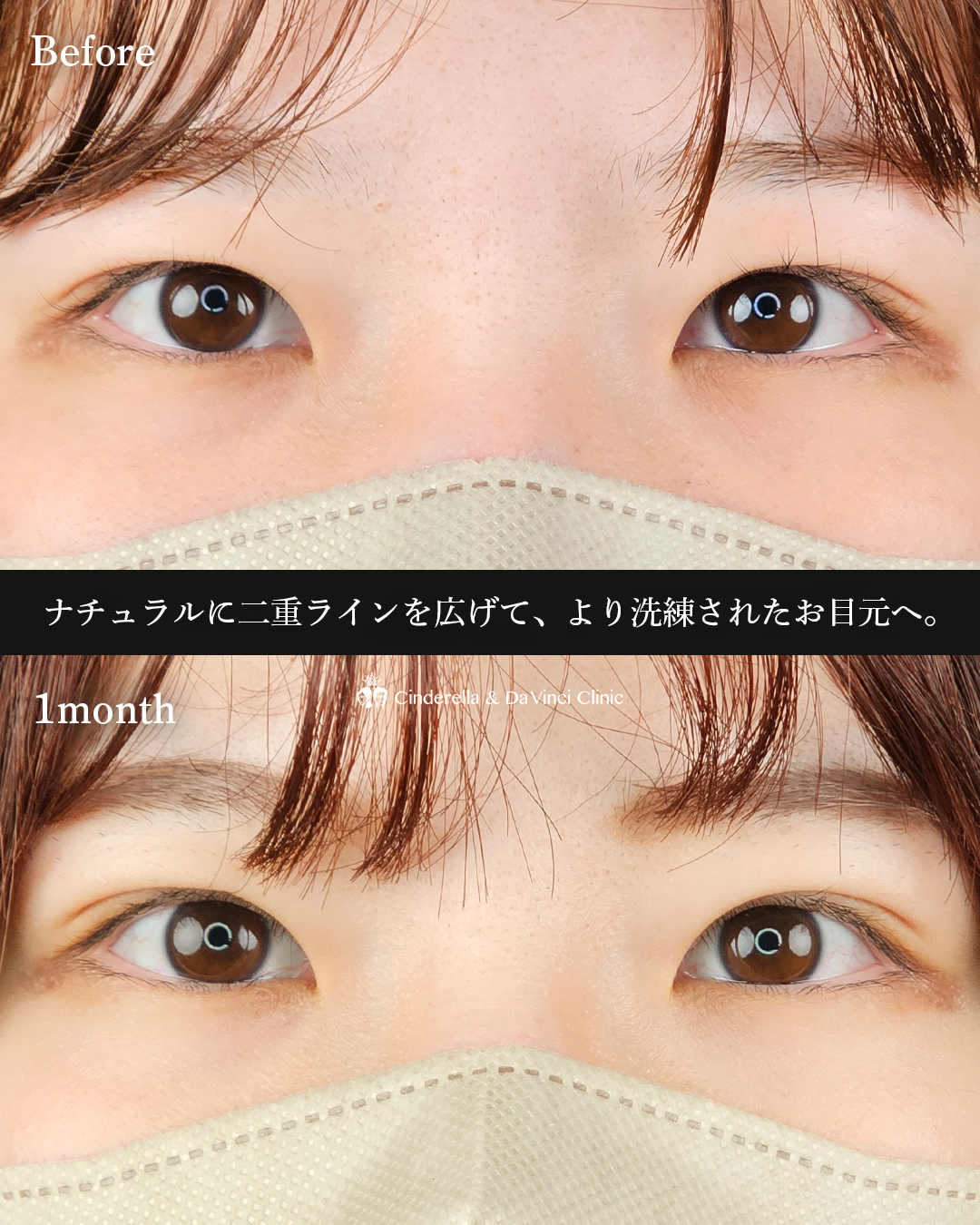 ナチュラル埋没の画像