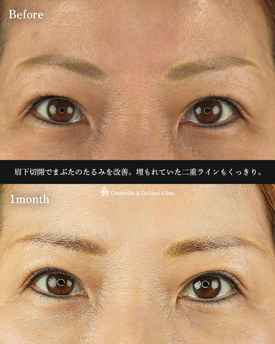 眉下切開でたるみ切除の画像