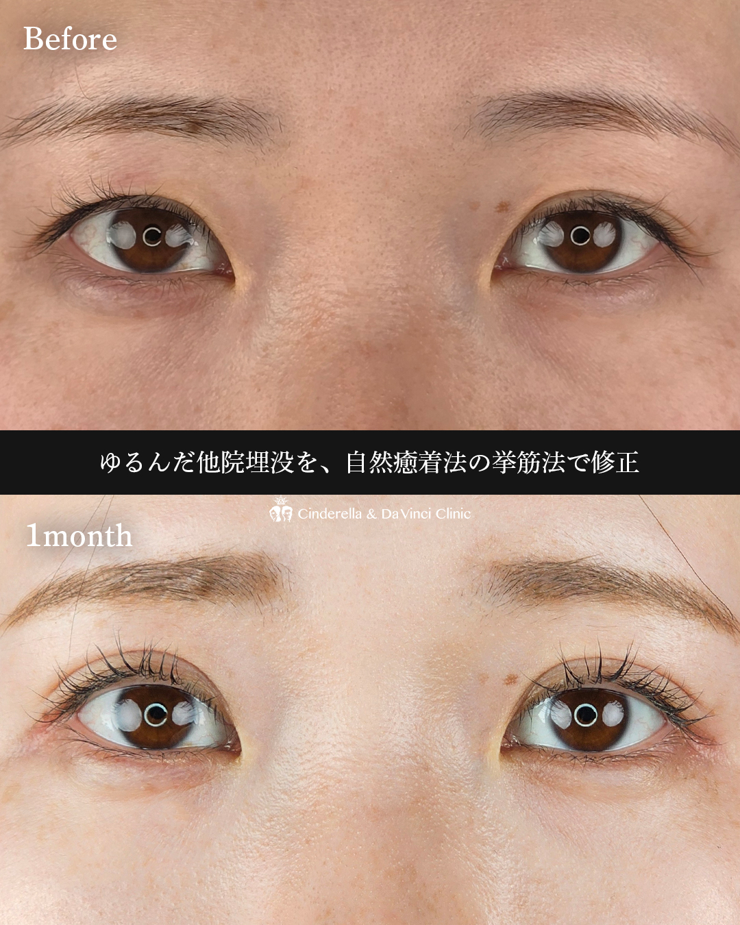 自然癒着法で二重にの画像