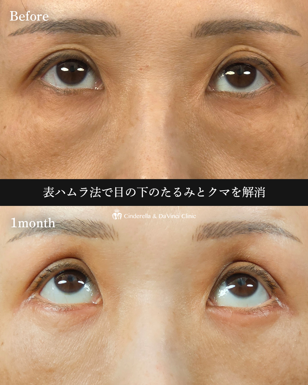 たるみとクマ解消の画像