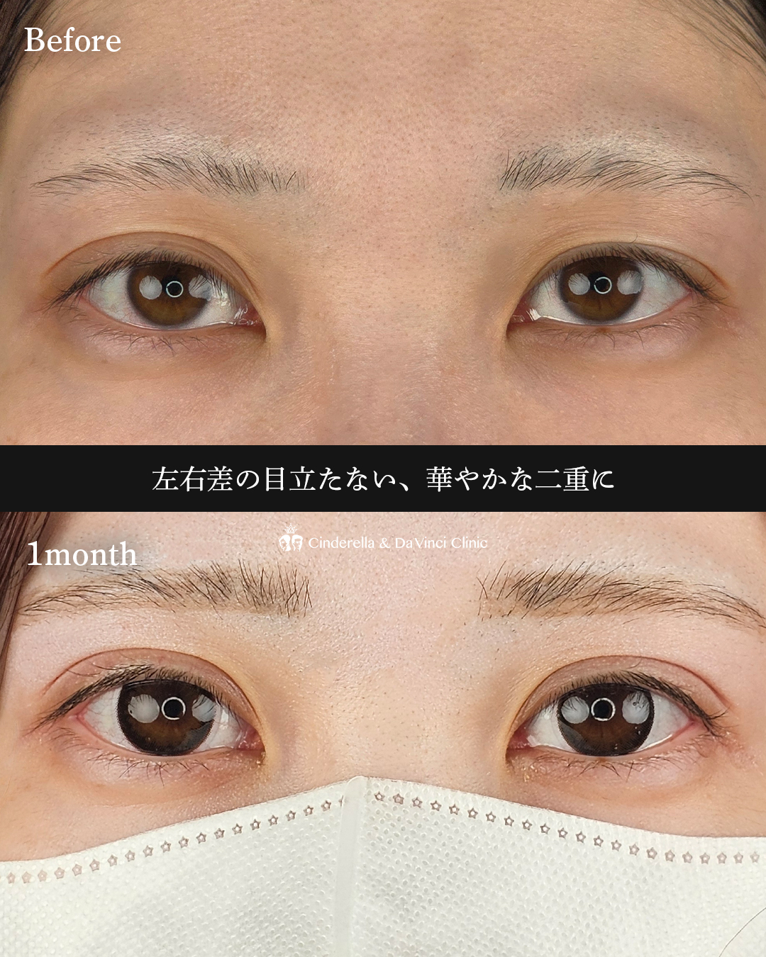 左右差を整えるの画像