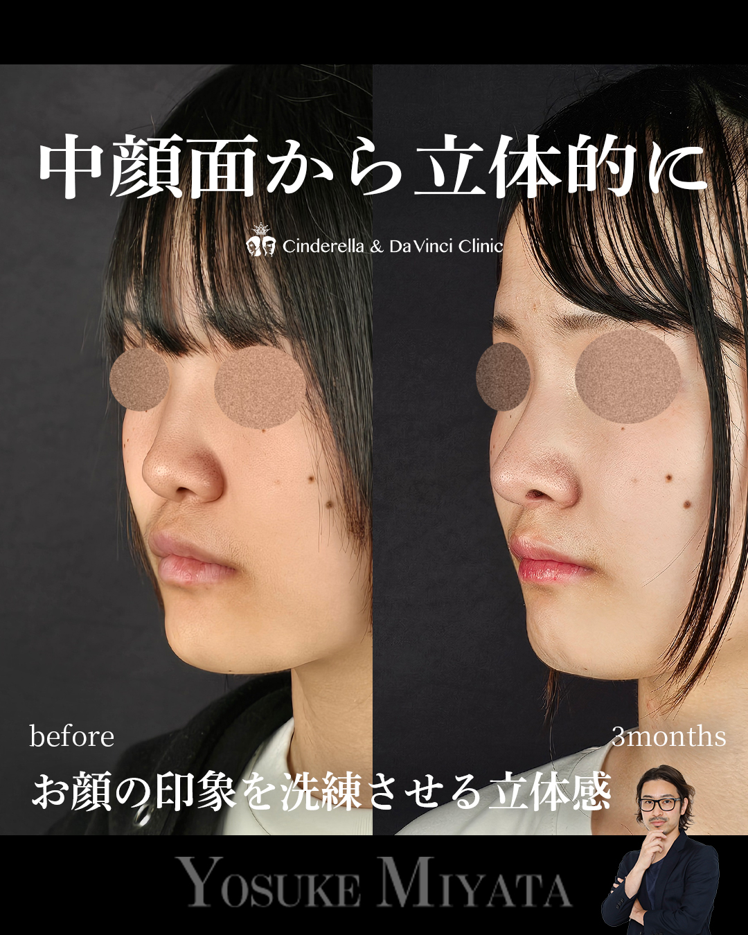 横顔に立体感を出すの画像