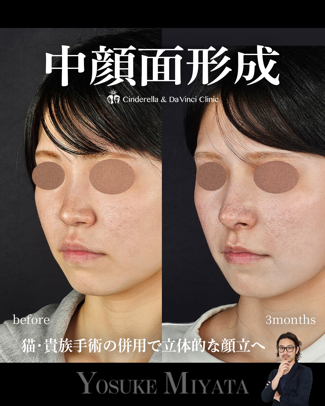 中顔面形成の画像