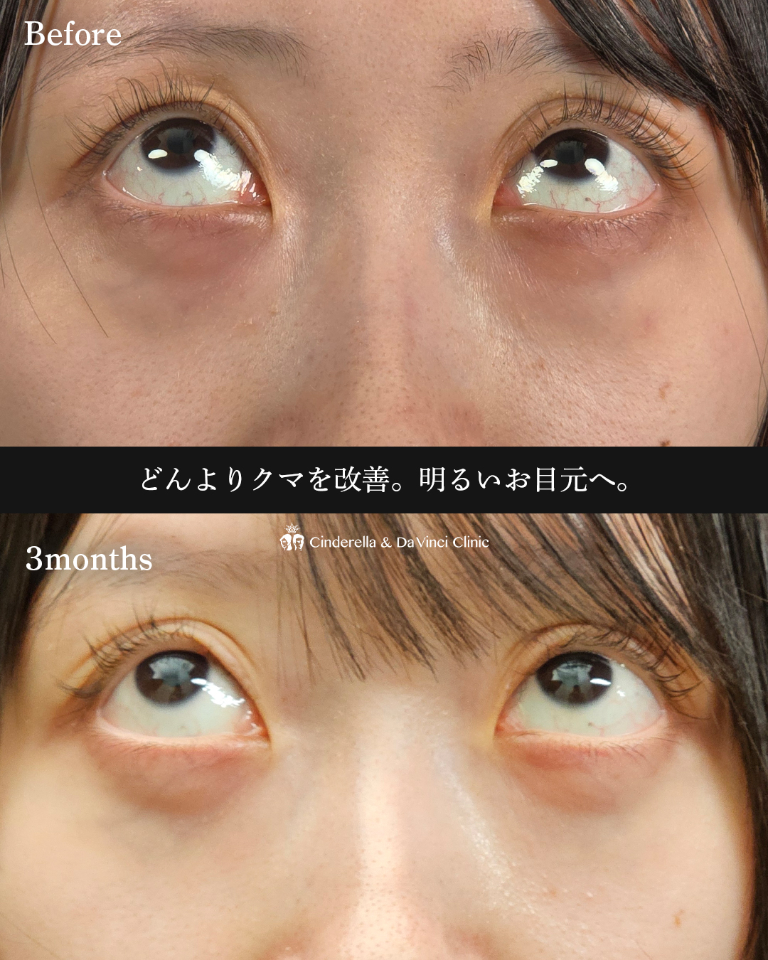 どんよりクマ改善の画像