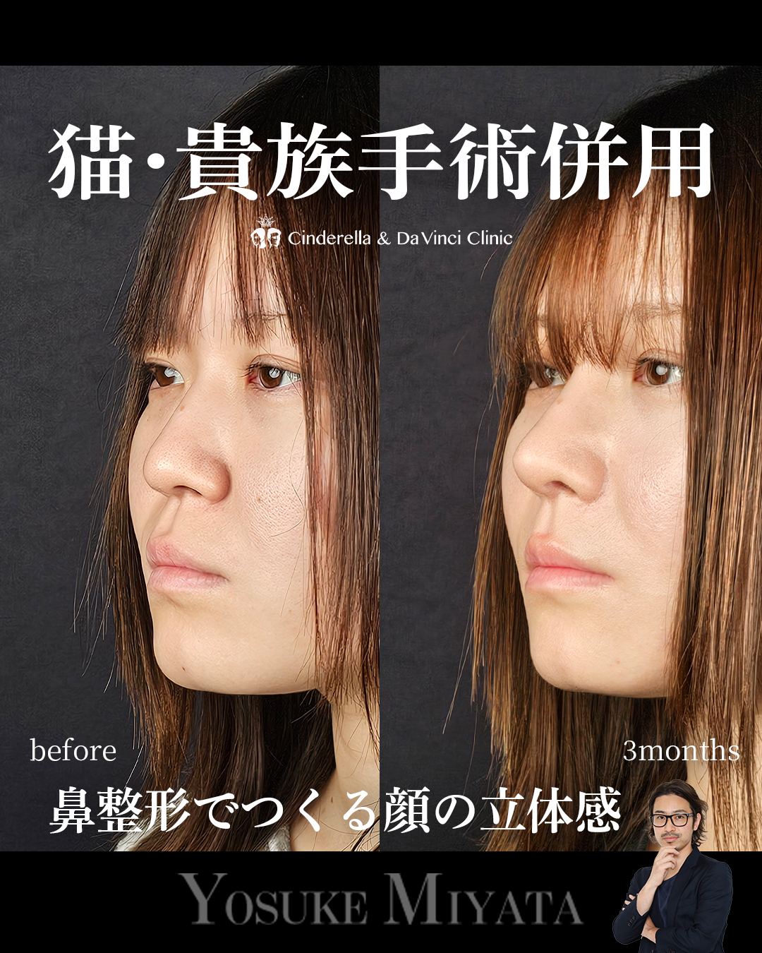 鼻整形のみで垢抜けの画像