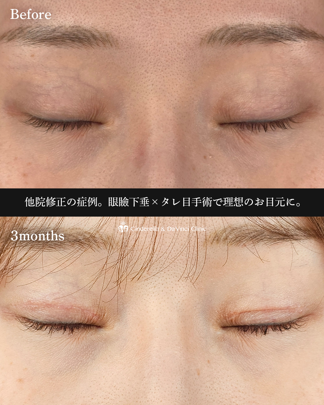 目元の他院修正の画像