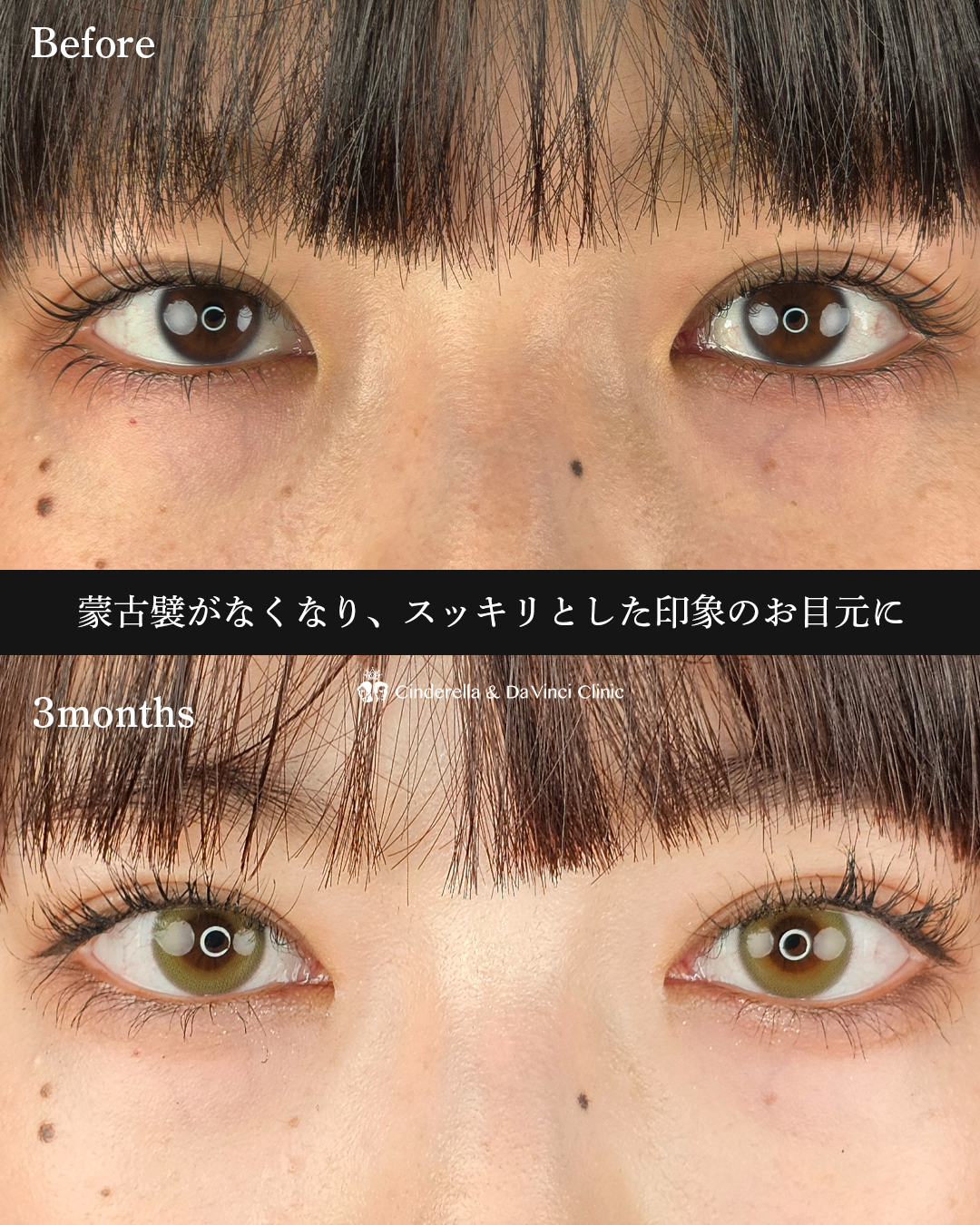 目頭切開のみの画像