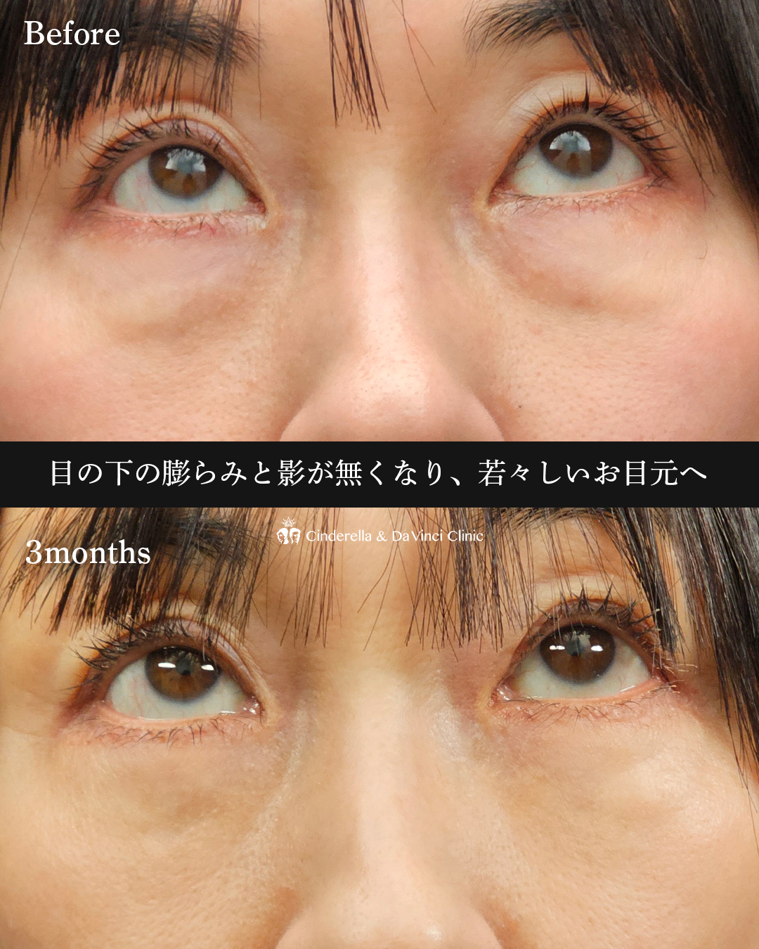 表ハムラ法の画像