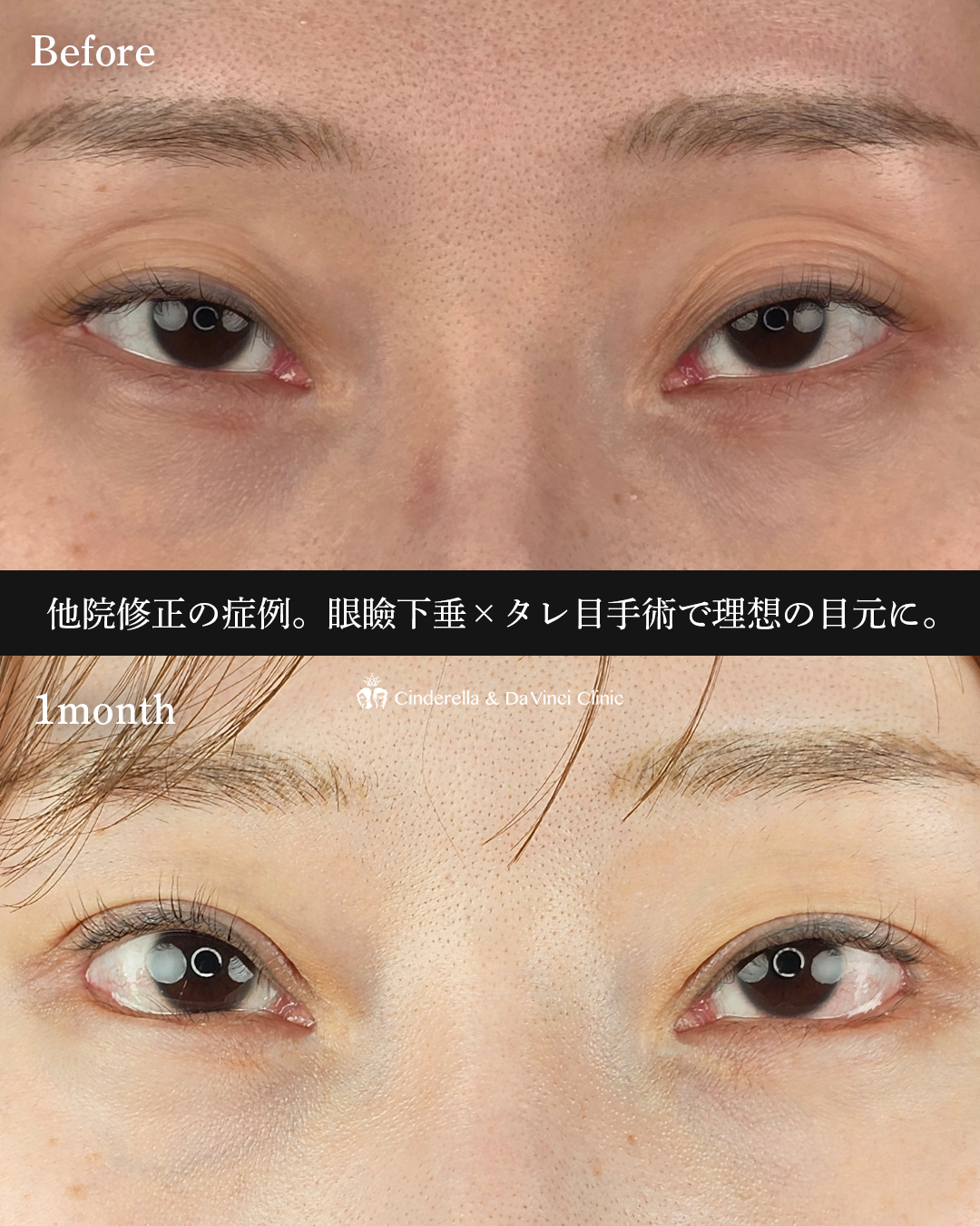目元の他院修正の画像