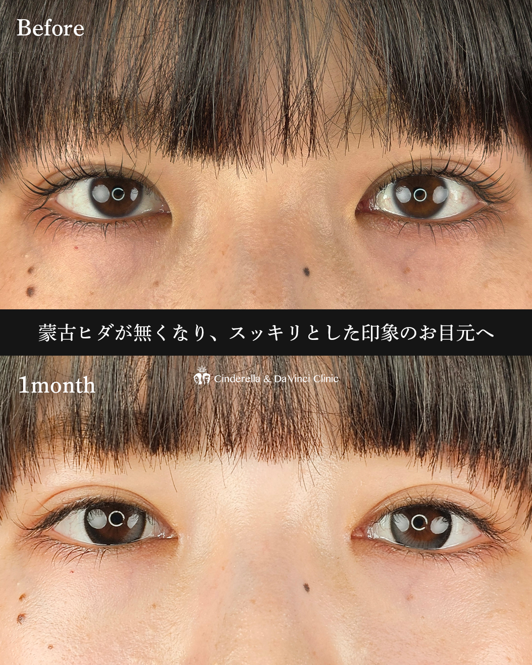 目頭切開のみの画像
