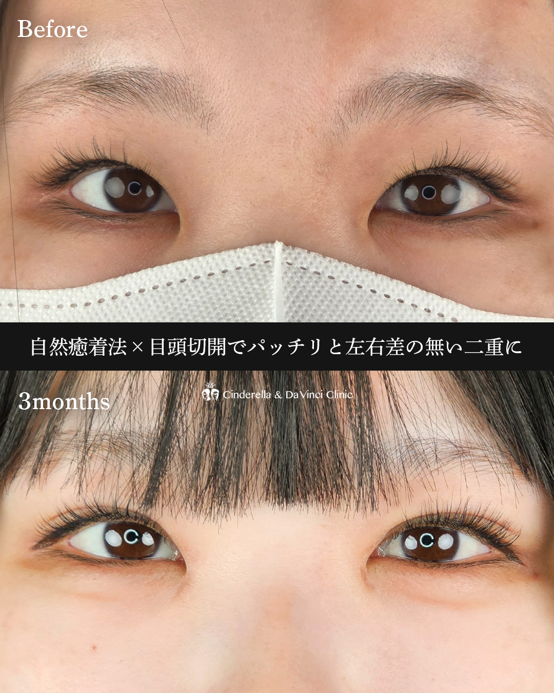 埋没×目頭の画像