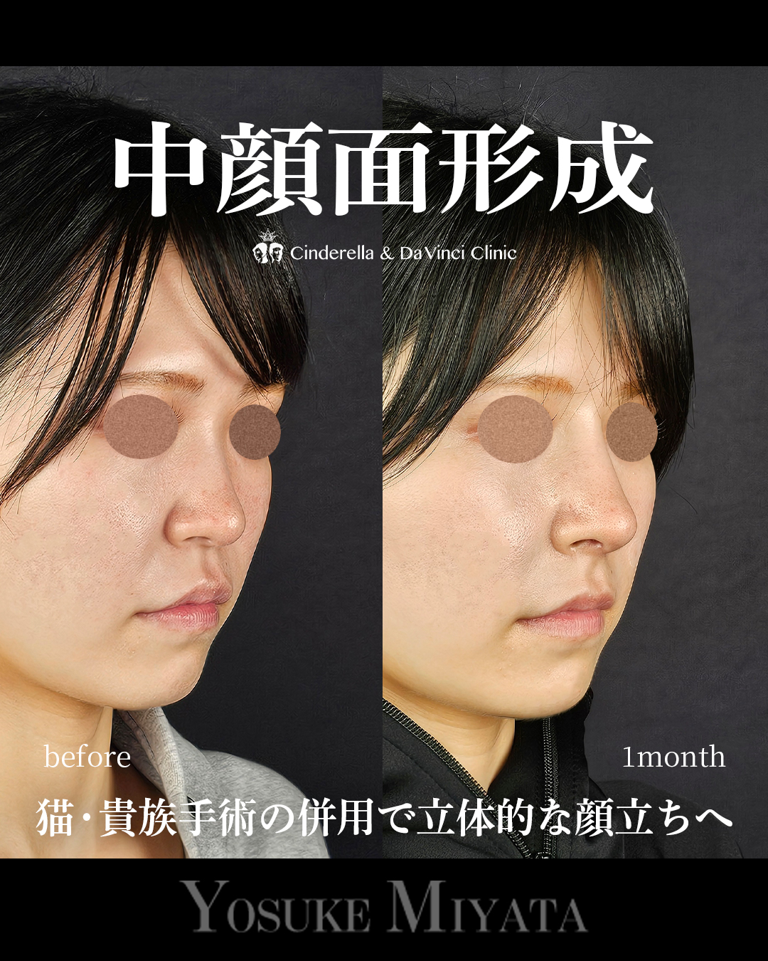 中顔面形成の画像