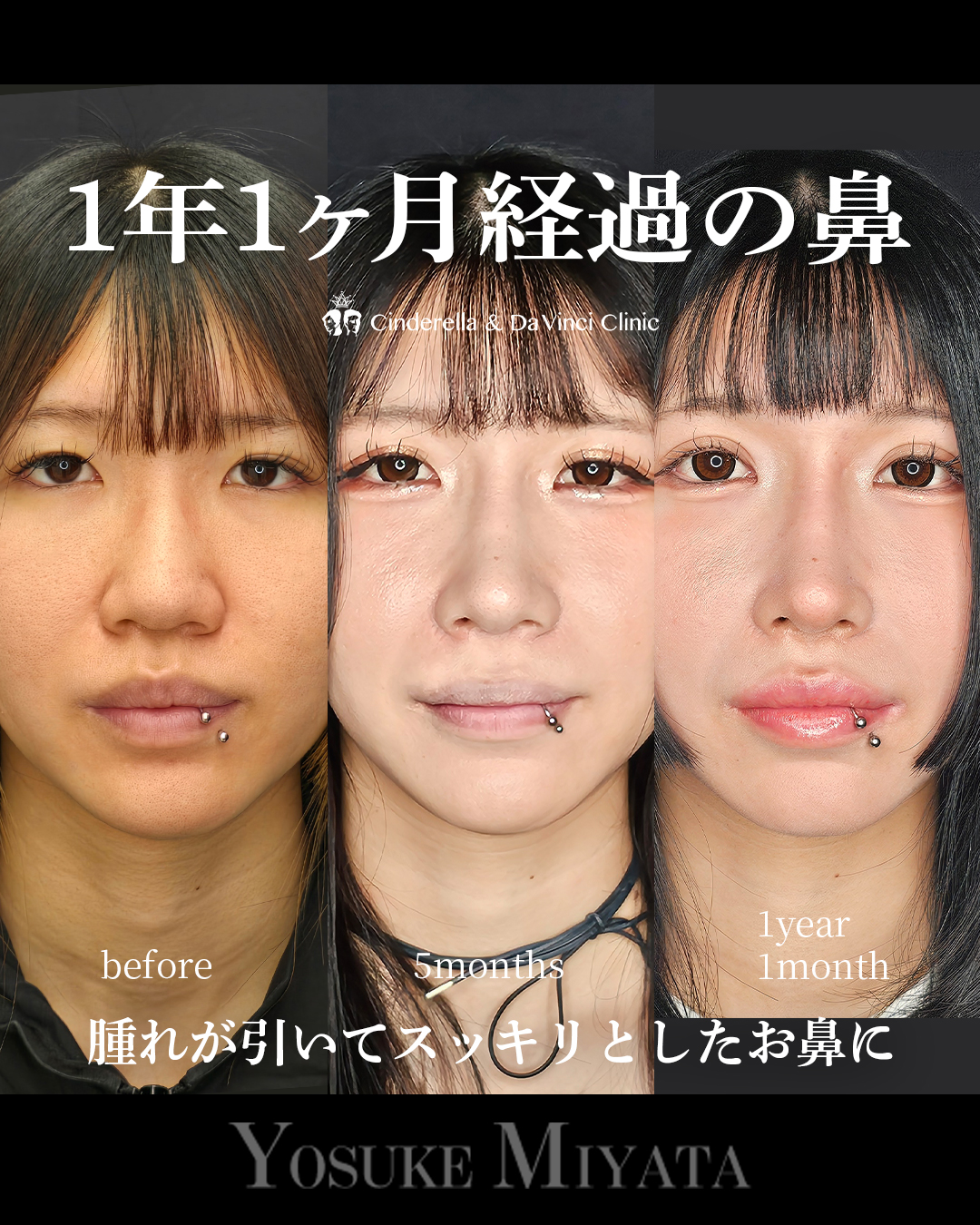1年1ヶ月経過の鼻の画像