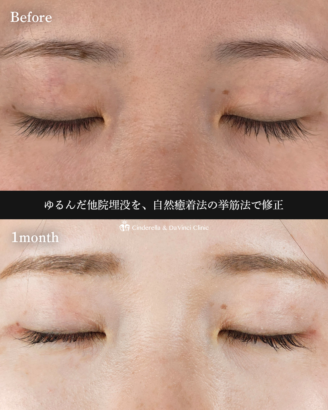 自然癒着法で二重にの画像