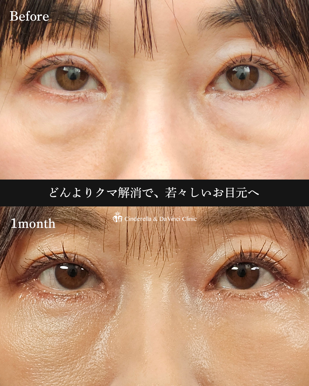 表ハムラ法の画像